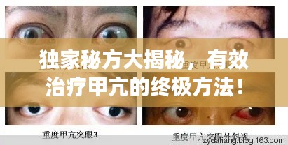 独家秘方大揭秘，有效治疗甲亢的终极方法！